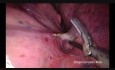 Full Anatomical Dissection for Lobectomy by Using only Energy Devices