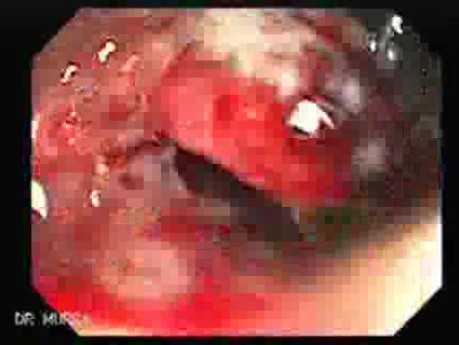Familial Adenomatous Polyposis (24 of 36)