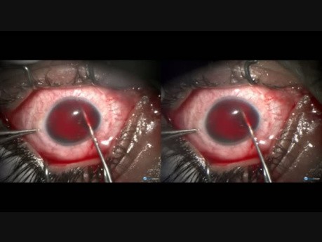 Coats Disease - Reverse Cyclodialysis Plus Suprachoroidal Drainage