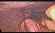 Laparoscopic Resection of Ileal Neuroendocrine Tumor