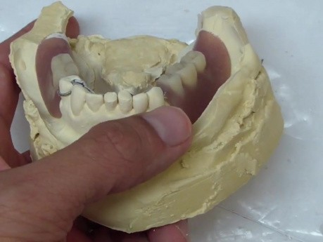 Removable Denture Clasp Repair Part 3 - Denture On Cast