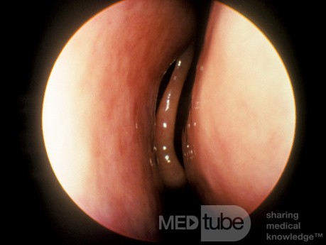 Lateralized [Collapse] Middle Turbinate [right]