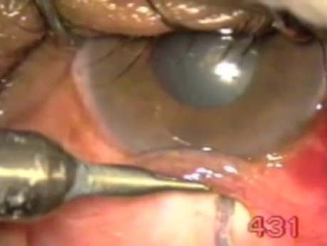 Transciliary Filtration - Fugo Blade