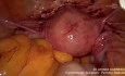 Endometrial Cancer Surgery – Sentinel Node