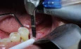 Triangular Ridge Preparation - Using a Round Pilot Drill
