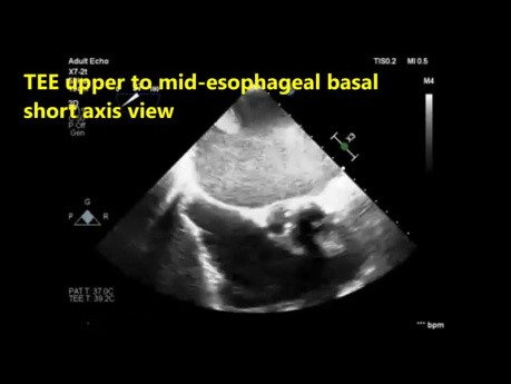 A Transesophageal Echocardiography (Tee) Quiz