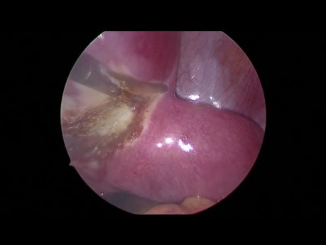 Unicornuate Uterus