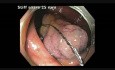 Colonoscopy Goes Awry - Cecal EMR Bleed - clip B
