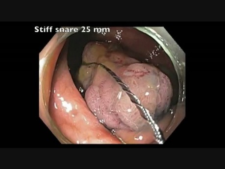 Colonoscopy Goes Awry - Cecal EMR Bleed - clip B