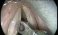 Accidental Avulsion of Vocal Fold Polyp - Perfect Excision