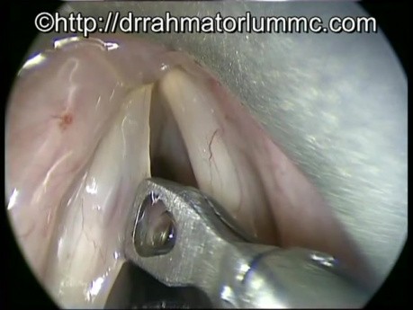 Accidental Avulsion of Vocal Fold Polyp - Perfect Excision