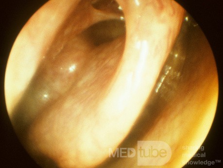 The Superior Meatus and Sphenoethmoidal Recess