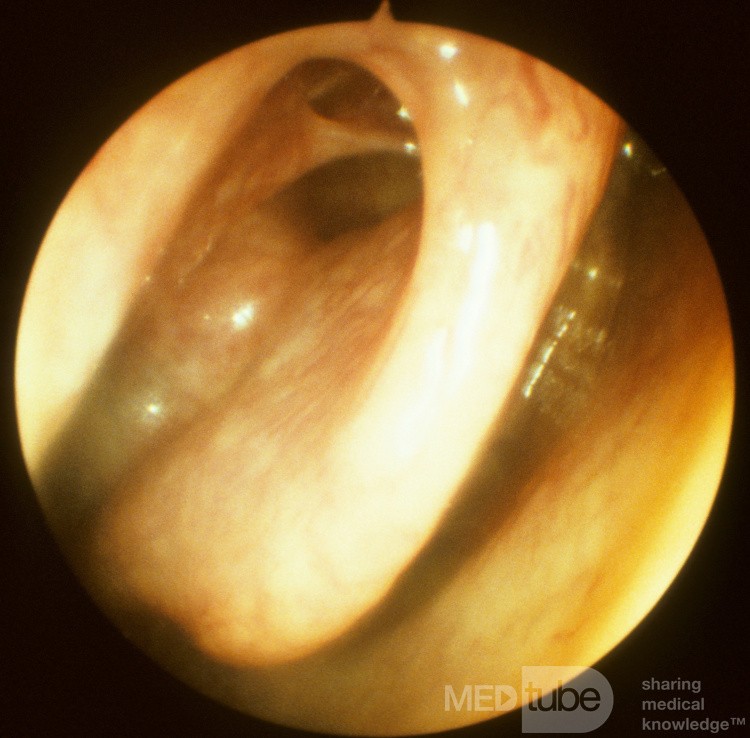 The Superior Meatus and Sphenoethmoidal Recess