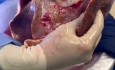 EVLP Induced Lung Edema in Patient with Tricuspid Valve Endocarditis