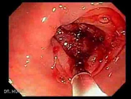 Colon Cancer - Endoscopy (3 of 3)