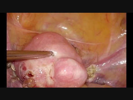 Day Care Hysterectomy, Simple Case. Uterine Artery Dissection.