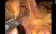 Total Transvaginal Right Hemicolectomy Using Single-Port Robotic Platform - A Novel CadavericTech