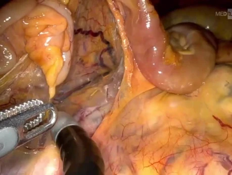 Total Transvaginal Right Hemicolectomy Using Single-Port Robotic Platform - A Novel CadavericTech