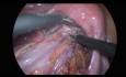 Laparoscopic TME for Ultra Low Rectal Cancer