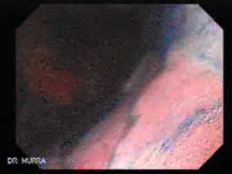 Chronic Gastritis (5 of 8)