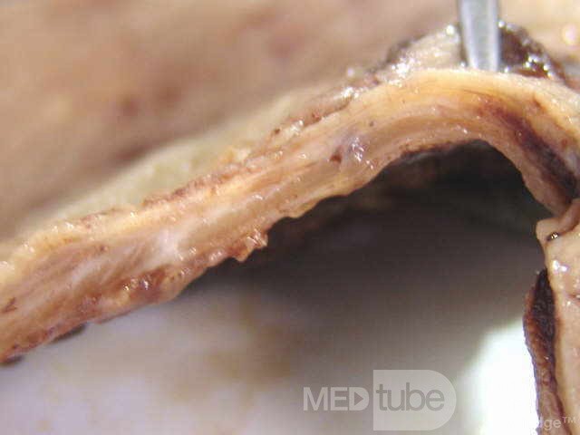 Small Gastric Adenocarcinoma of the Diffuse Ring Cell (18 of 19)