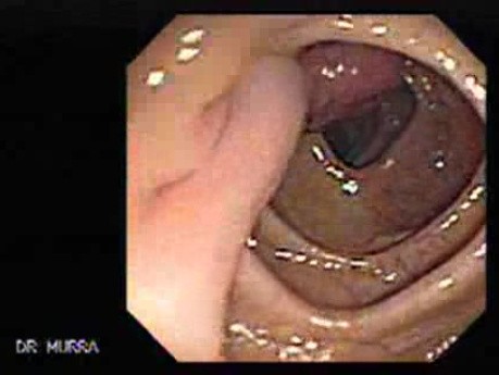 Polypectomy of Stalked Polyp (1 of 6)