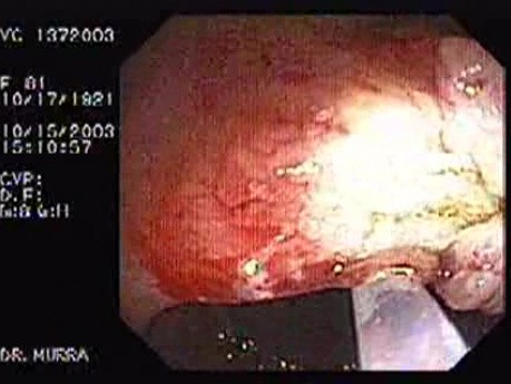 Tubulo - Villous Adenoma - Endoscopy (23 of 28)