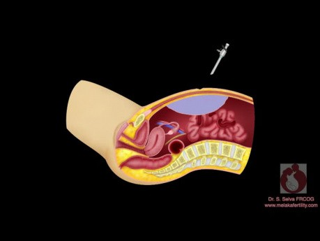 Carbon Dioxide Insufflation and First Trocar Insertion