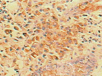 Small Gastric Adenocarcinoma of the Diffuse Ring Cell (8 of 19)