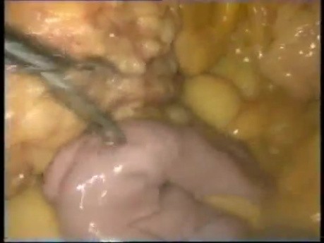 Conversion of Maison Technique to Roux En Y Gastric Bypass - Laparoscopy