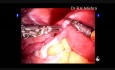 Robotic Fallopian Tube Recanalization Surgery