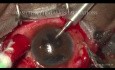 A Neglected Closed Globe Contusion Managed Using Scleral Tuck Lens