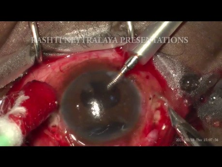 A Neglected Closed Globe Contusion Managed Using Scleral Tuck Lens