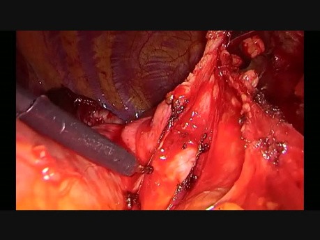 Subxiphoid Uniportal Combined Right Upper Lobectomy and Thymectomy
