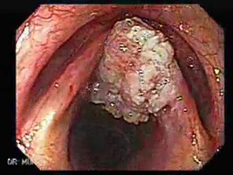 Squamous cell carcinoma of the larynx (1 of 3)