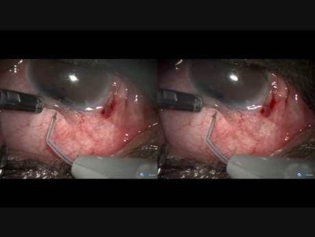 Advanced Glaucoma a Variation of Filtration Surgery