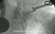 Anterior Percutaneous Reduction of Displaced C2 Fracture