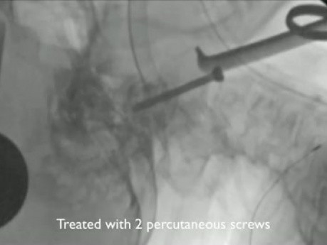 Anterior Percutaneous Reduction of Displaced C2 Fracture