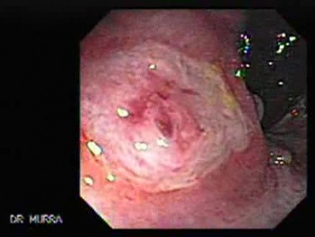 Rectal Dieulafoy’s Lesion (1 of 4)