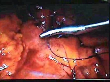 Jejunal Gastrointestinal Stromal tumor (GIST) (64 of 86)