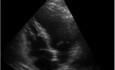 Echo Apical Wall Motion Abnormality of the Left Ventricle, Old Anterior Myocardial Infarction