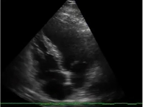 Echo Apical Wall Motion Abnormality of the Left Ventricle, Old Anterior Myocardial Infarction