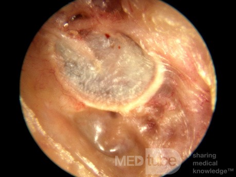 Keratosis Obturans Causing Bony External Canal Erosion