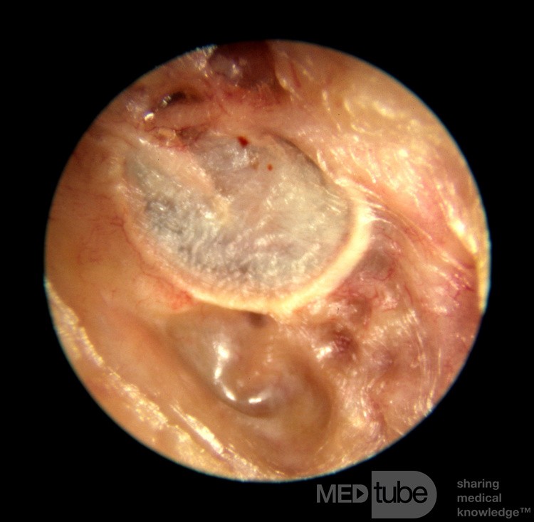 Keratosis Obturans Causing Bony External Canal Erosion