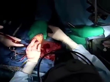 Heart Transplant with Inforcement of Anastomoses with Teflon Felt 