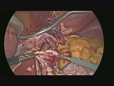 Laparoscopic Enucleation of Leiomyoma of Oesophagus