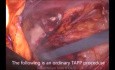 Laparoscopic Management of Strangulated Inguinal Hernia