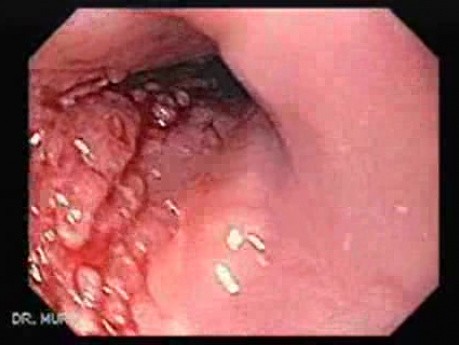 Esophageal Squamous Cell Carcinoma - Visualization of Esophageal Mucosa and Tumor