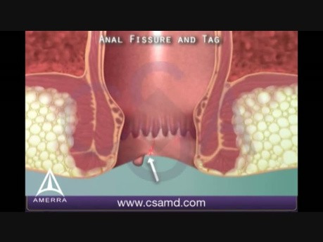 Anal Fissure - 3D Medical Animation