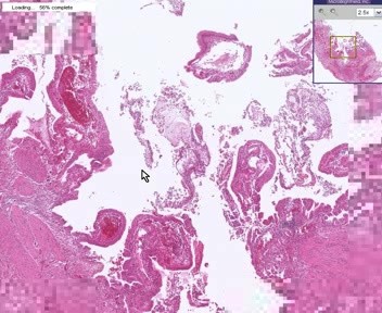 Acute Cholecystitis